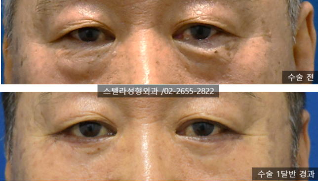 화곡동 성형 까치산 하안검 /하안검지방재배치 잘하는곳 (경험 많은 오목교 스텔라의원) 관련 이미지 5