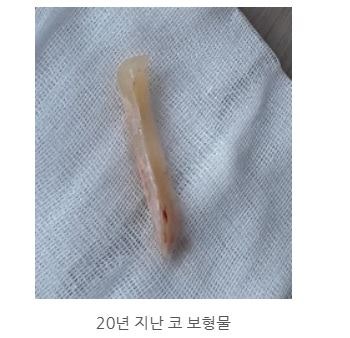 목동 성형외과 #코 보형물 제거 , 코 염증 현상 관련 이미지 2