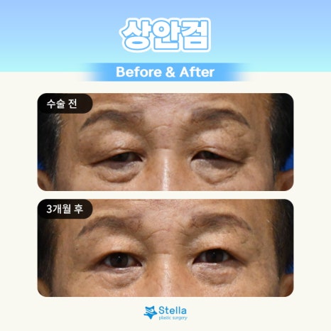 눈 수술 후, 빠른회복을 위한 방법은 ??  스텔라가 알려드릴게요!  (오목교 스텔라성형외과) 관련 이미지 5