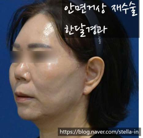 화곡동 /까치산/ 목동성형외과 (스텔라의원) 3월까지 안면거상 재수술 이벤트 비용 ? 주목! 관련 이미지 3