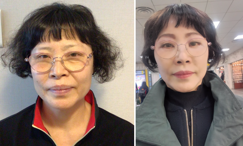 눈상담 받으러 왔다가 풀안면거상까지 하게된 60대중반 중년 어머님 (전/후) /목동 성형외과 스텔라성형 관련 이미지 23
