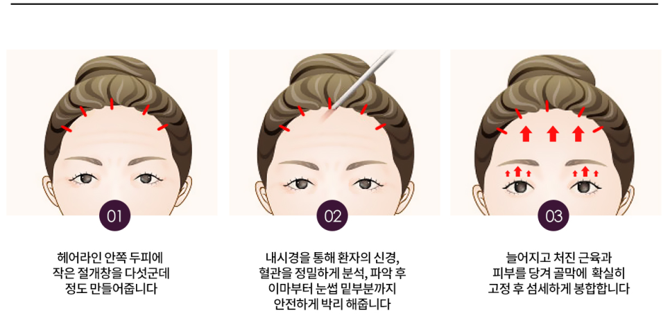 목동,화곡동,영등포 성형외과 /(눈성형) 이마거상 엔도타인 정품 확인하는방법 꿀팁! 필수 (수술직후 사진 有) 스텔라성형외과 관련 이미지 2
