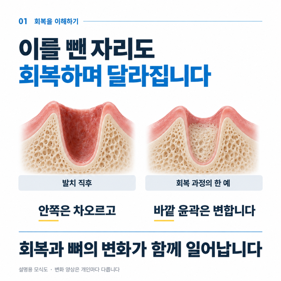 발치 후 임플란트 시기, 바로 심는 경우와 기다리는 경우 관련 이미지 2