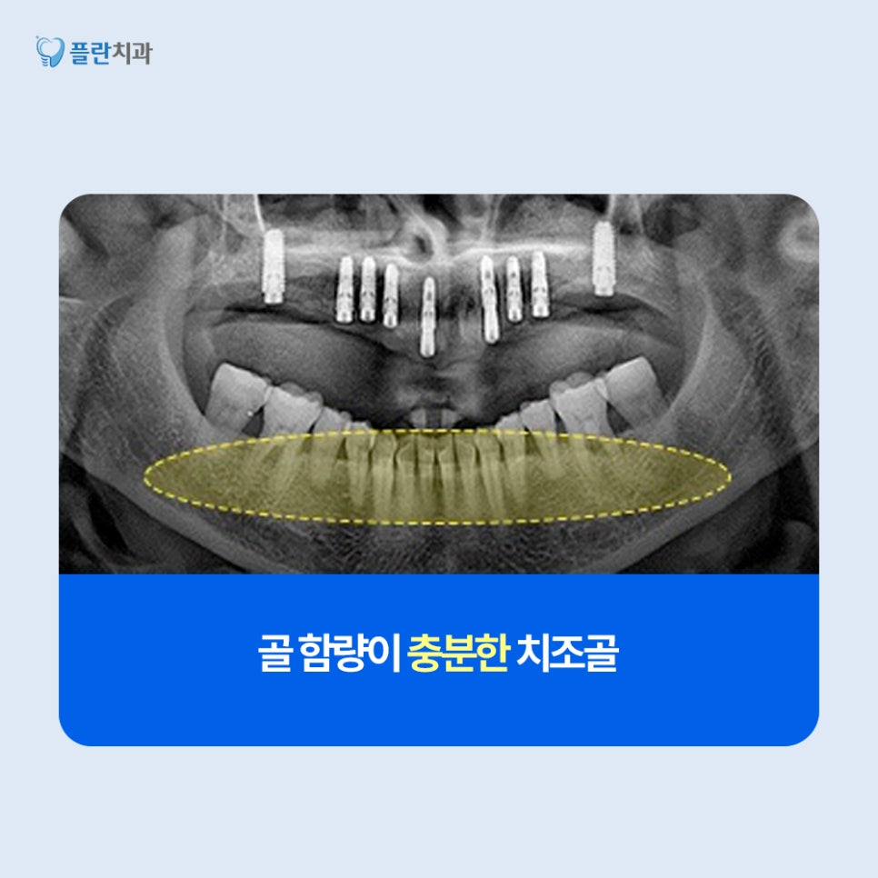 임플란트 전, 뼈이식술 꼭 진행해야 하는 이유는? 관련 이미지 4