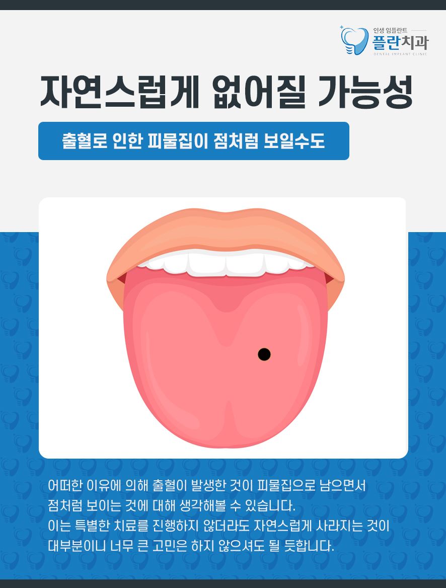 혓바닥검은점 원인과 대처 방법 무엇일까 관련 이미지 4
