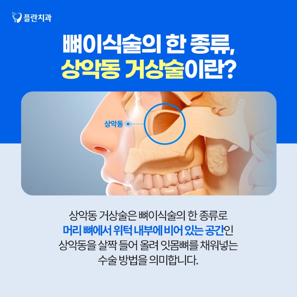 임플란트 전, 뼈이식술 꼭 진행해야 하는 이유는? 관련 이미지 7