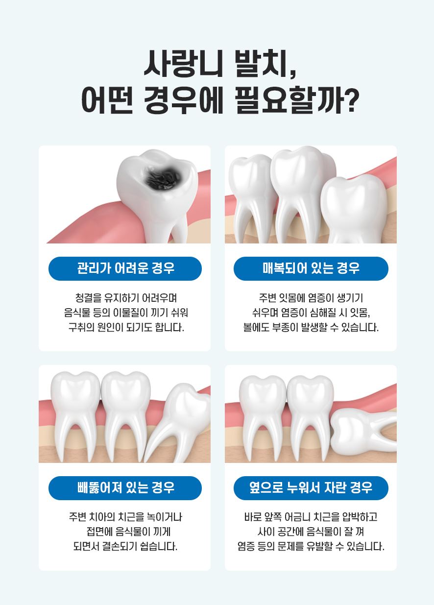사랑니매복 된 상태에서는 발치 꼭 해야 할까? 관련 이미지 3
