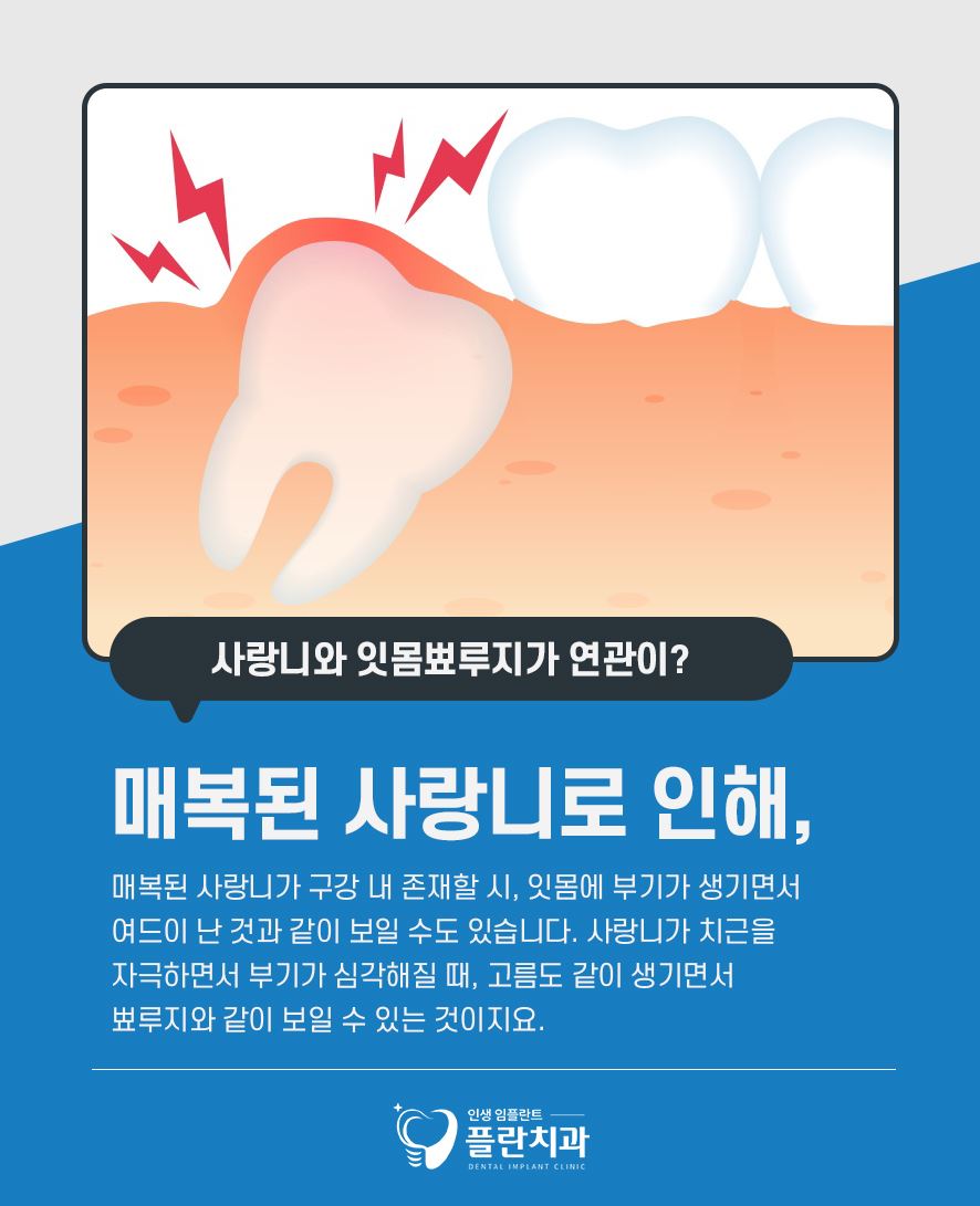 잇몸뾰루지 났다면 원인과 대처 방법은 관련 이미지 4
