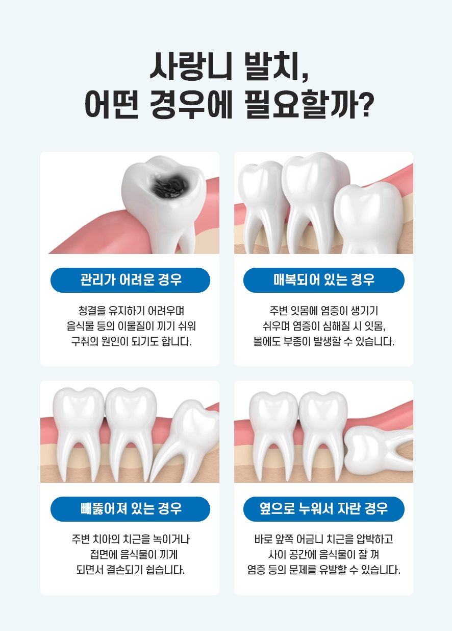 서울사랑니치과 통증 줄여 원활히 회복하도록 관련 이미지 4