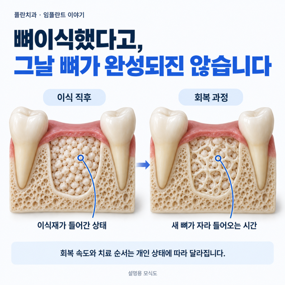 임플란트 뼈이식, 꼭 해야 할까요?압구정 치과에서 알려드립니다. 관련 이미지 5