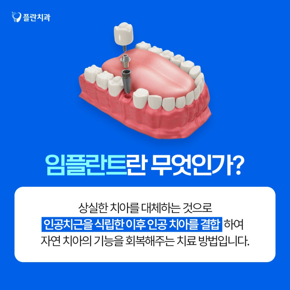 임플란트의 치료방법과 구조적 특징에 대하여 관련 이미지 1