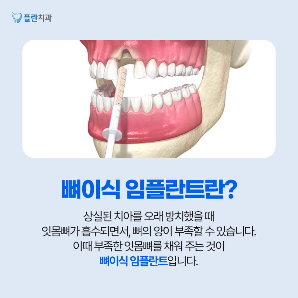 임플란트 전, 뼈이식술 꼭 진행해야 하는 이유는? 관련 이미지 2