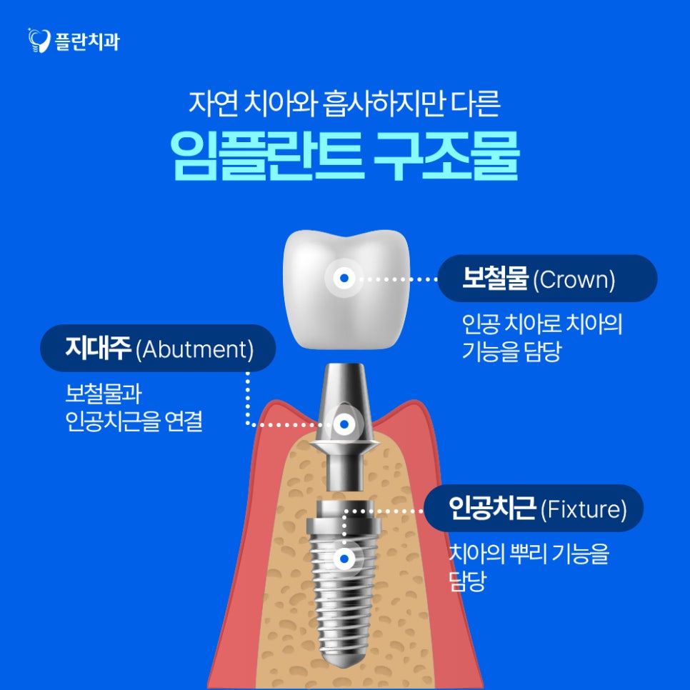 임플란트의 치료방법과 구조적 특징에 대하여 관련 이미지 2