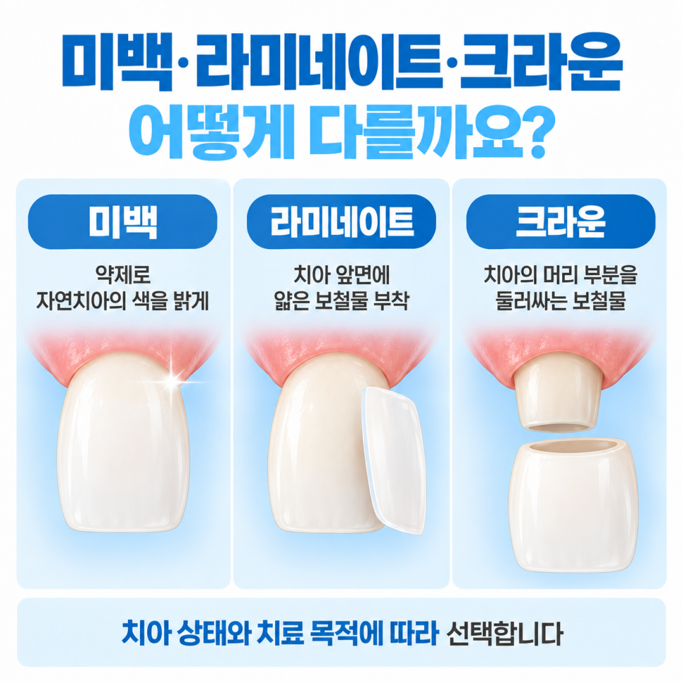 라미네이트란? 치아에 뭘 붙이는 건가요? 관련 이미지 3