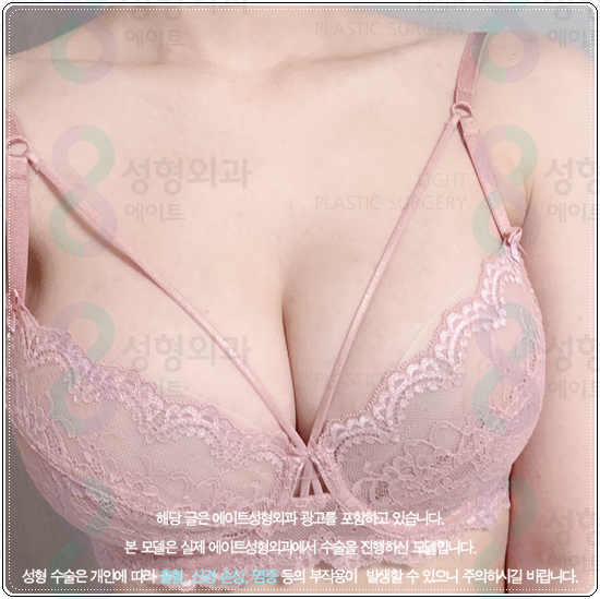 How Much Does Breast Augmentation with Mentor Xtra Cost? What to Know About Feel and Precautions Before and After Surgery image 2