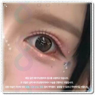 보통 자연유착과 밑트임을 같이하면 붓기는 언제 빠질까요? 관련 이미지 2