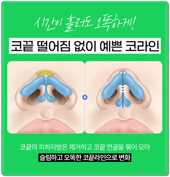 Bokko Rhinoplasty Review Summary! In Sinsa-dong, what are the costs of bokko surgery and the criteria for choosing a good clinic? image 21