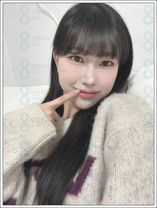 매부리코 수술 비용 후기 정보 총정리 관련 이미지 3