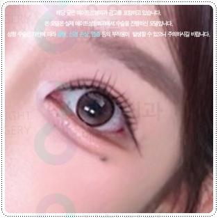 강남 쌍커플 알아볼 때, 가격보다 먼저 확인해야 할 것 관련 이미지 6