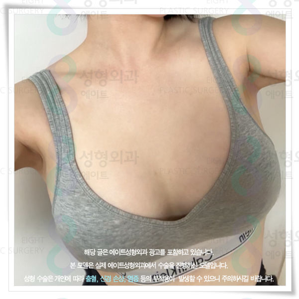 가슴성형 시 사용되는 보형물 종류와 가격 차이는 왜 생기나요? 관련 이미지 3