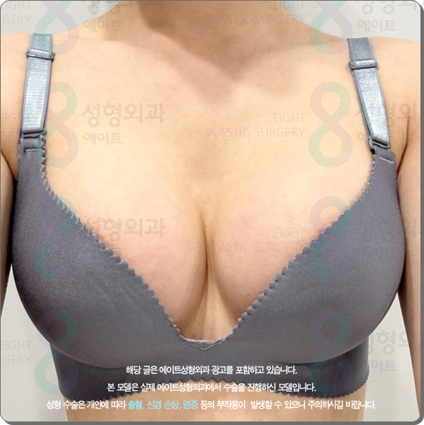가슴확대 수술 어떤 보형물 종류로 해야 후기가 좋은가? (ps. 비용) 관련 이미지 1
