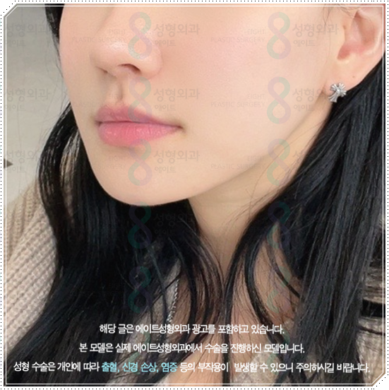 울쎄라피프라임 효과 얼마나 갈까? 300샷 통증과 후기, 가격까지 관련 이미지 4