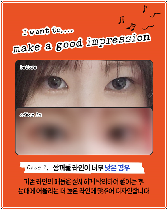 첫 쌍꺼풀 수술을 절개로 하고 눈 재수술은 매몰법(자연유착)으로 못하나? 비용 붓기는? 관련 이미지 11