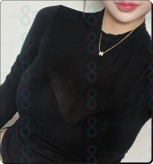 가슴보형물 종류 장단점, 가슴확대수술전후 후기 찾아보실때 관련 이미지 2