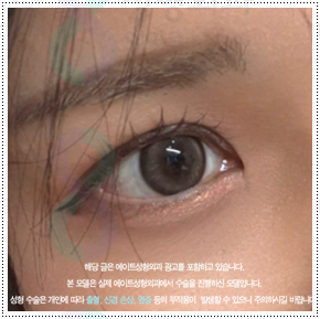 쌍커풀재수술 절개쌍수 말고 매몰은 못하나? 재수술 시 가격 얼마? 관련 이미지 1