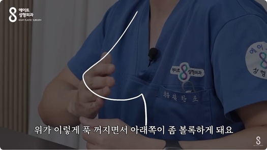 Mentor Boost: How Is It Different from Existing Mentor Implants? Eight Plastic Surgery Clinic image 22