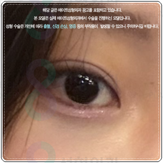 세미아웃라인 쌍수를 매몰로 하는법? 발품 비용 상담 후기 참고용 관련 이미지 6