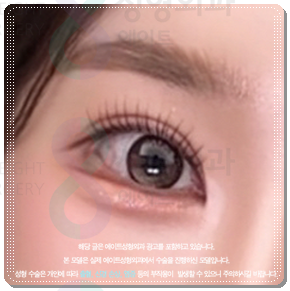 수술 가격이 다른 이유? 매몰과 절개 어떤 쌍꺼풀 재수술을 해야할까? 관련 이미지 5