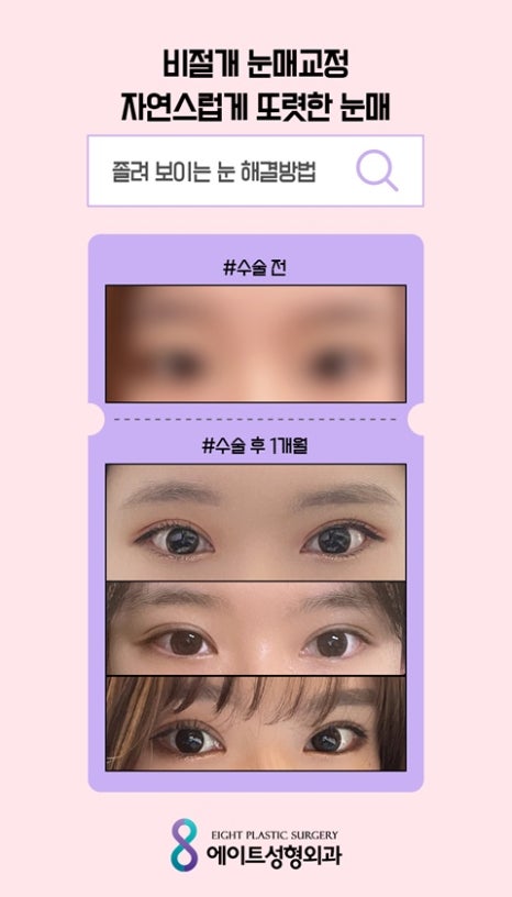 압구정눈매교정 눈매교정잘하는곳 눈매교정유명한병원 안검하수잘하는병원 관련 이미지 6