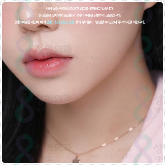 Ultherapy Lifting with 300 Shots: What Are the Price and Before-and-After Changes You Should Know Before the Procedure? image 1