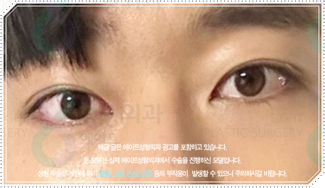 남자 쌍수 비용, 눈매교정 · 앞트임까지 하면 얼마나 달라질까? 관련 이미지 2
