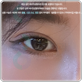 쌍꺼풀 아웃라인? 인라인? 수술 고민, 자연유착과 절개의 비용 차이는? 관련 이미지 3