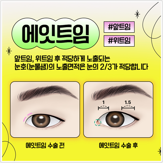 쌍꺼풀 자연유착과 매몰, 절개 사이에서 고민이라면? 비용과 풀림 가능성을 낮추는 수술 방법은? 관련 이미지 9