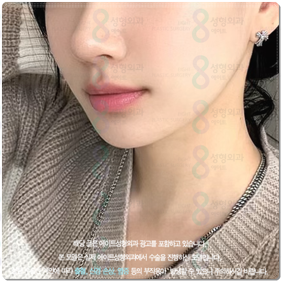 울쎄라 300샷 가격과 효과는? 100샷 후기&middot;전후 차이까지 비교 관련 이미지 1