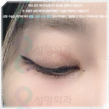 내 눈에 맞는 앞트임 필요할까? 수술 방법과 대략적인 비용 안내 관련 이미지 5