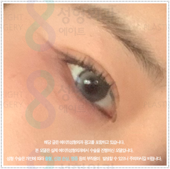 쌍꺼풀 자연유착과 매몰, 절개 사이에서 고민이라면? 비용과 풀림 가능성을 낮추는 수술 방법은? 관련 이미지 1