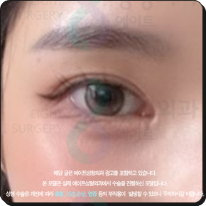 쌍꺼풀수술은 꼭 비절개가 좋을까? 부분절개와 절개의 비용 대비 효과는? 관련 이미지 4