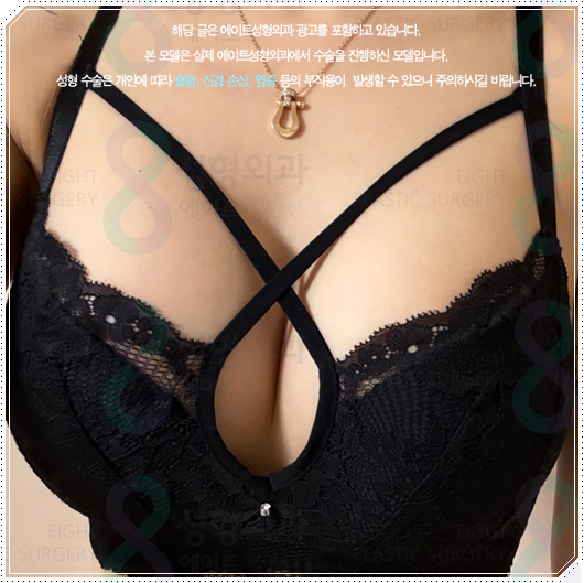 가슴성형으로 예쁜 가슴을 만들려면? 모티바 멘토 바운스 보형물에 대해 관련 이미지 4
