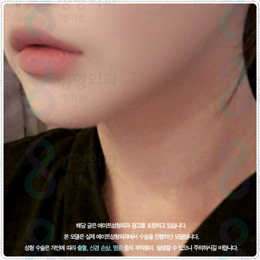 울쎄라 샷 수, 600샷과 300샷 차이점? 부작용 걱정과 가격 부담을 낮추려면 관련 이미지 3