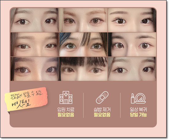 A Review of Upper Blepharoplasty Costs That Was Worth Every Penny! From How to Remove Mongolian Folds to Pricing and Recovery Care Tips image 14