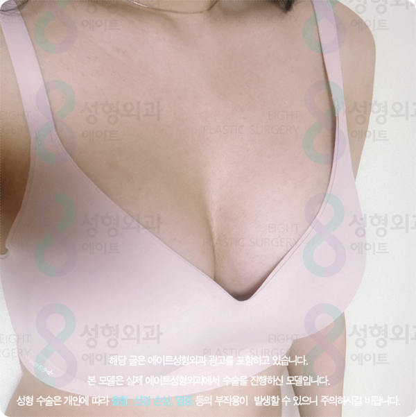 Apgujeong Plastic Surgery Clinics: Sharing Information on Breast Augmentation and Motiva Surgery image 5