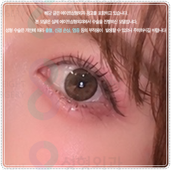 Preparing for the Cost and Swelling When Combining Medial and Lateral Canthoplasty with Double-Eyelid Surgery: A Comparison image 1