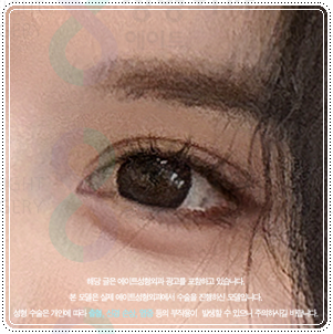 강남눈성형 | 쌍수 병원을 찾는다면? 비용, 후기, 선택전에 체크해보세요 관련 이미지 3