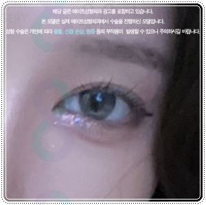 연예인 쌍꺼풀 종류? 평균 쌍커풀 수술비용 차이는 왜 나나요? 관련 이미지 3