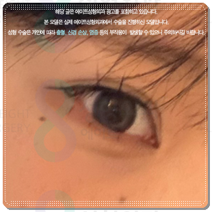 쌍꺼풀 라인을 다시 잡는 재수술, 매몰 방법과 비용은? 관련 이미지 6