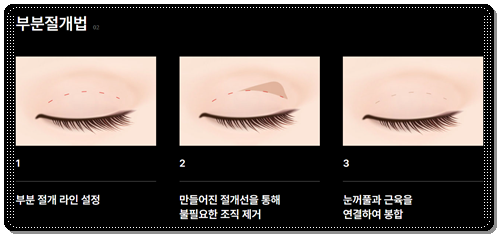Why Choose Partial Incision Instead of Non-Incision Double-Eyelid Surgery? Meaning, Cost, and When Does the Swelling Go Down? image 6
